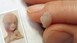 "No es un residuo médico": Tomó fotos de su bebé abortado y sacó a la luz una cruel verdad
