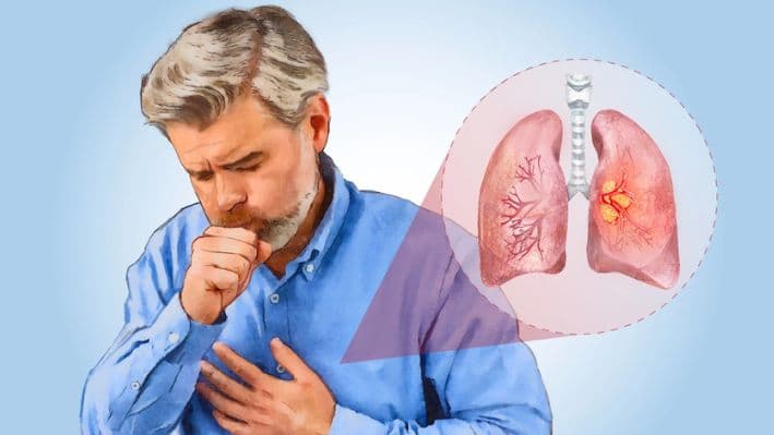 El cáncer de pulmón suele desarrollarse de forma silenciosa, y los síntomas aparecen solo cuando la enfermedad ha avanzado. (Ilustración de The Epoch Times, Shutterstock).