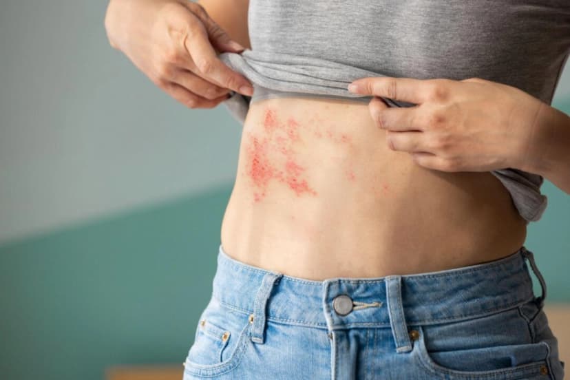 Los pacientes con herpes zóster suelen desarrollar grupos de pequeñas ampollas que pueden causar un dolor intenso incluso con el más mínimo contacto. (aslysun/Shutterstock)