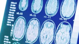 Cómo se relaciona la presión arterial alta con la enfermedad de Alzheimer