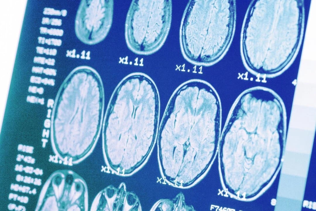 Cómo se relaciona la presión arterial alta con la enfermedad de Alzheimer