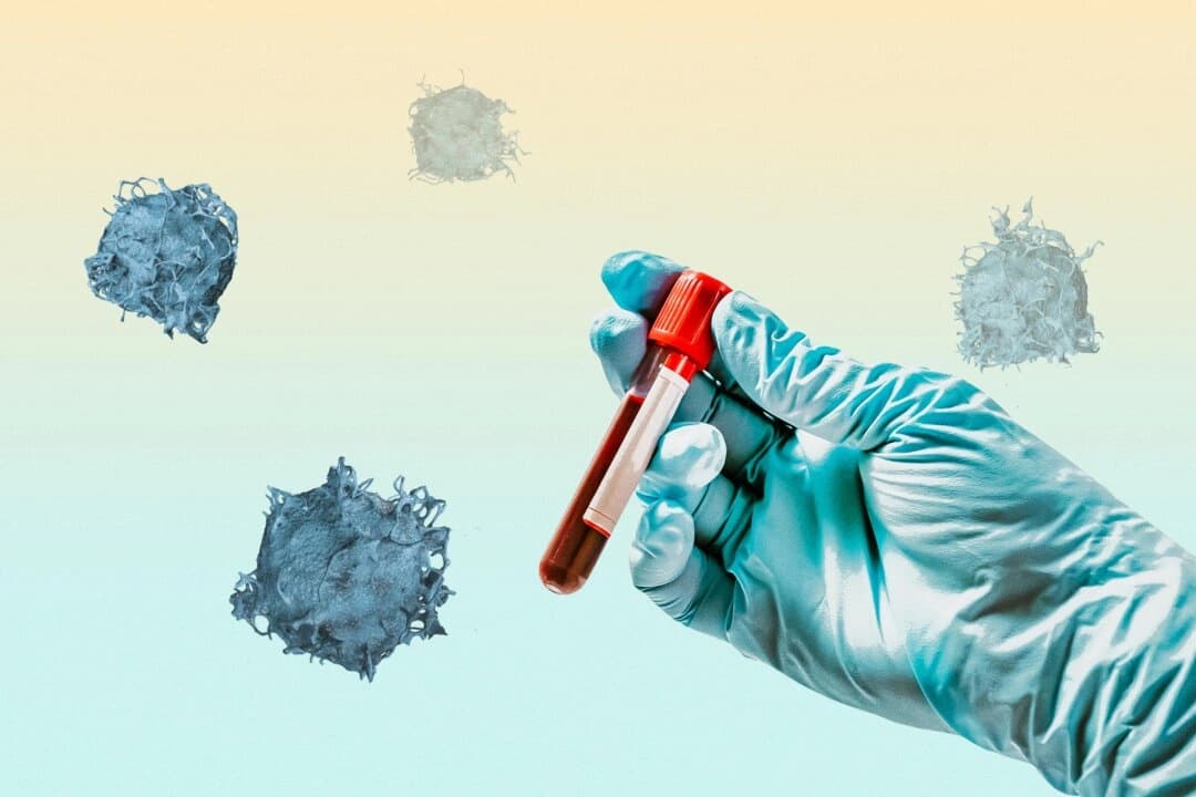 Detección del cáncer de próstata: Esto es lo que necesita saber para tomar una decisión informada