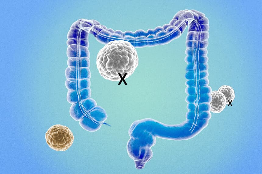 Revelan cuándo se considera curado el cáncer de colon: estudio