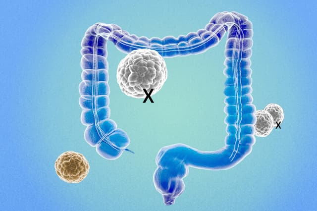 Revelan cuándo se considera curado el cáncer de colon: estudio