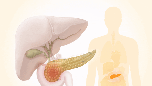 Cáncer de páncreas, un cáncer silencioso y mortal: Síntomas a los que debe que estar atento