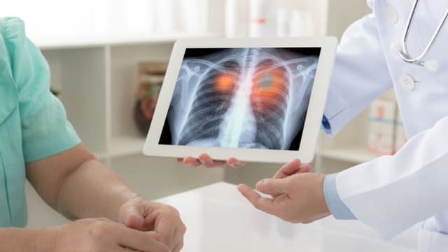 Ante el creciente impacto del cáncer de pulmón, el más letal del mundo, el director médico de Amgen México, Max Saráchaga, hizo un llamado este jueves a las personas con factores de riesgo a no postergar las revisiones médicas y acudir a chequeos que permitan una detección temprana. (EFE/ Amgen)