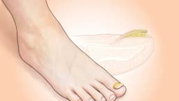 Hongos en las uñas de los pies: una infección persistente que afecta a 1 de cada 10 personas