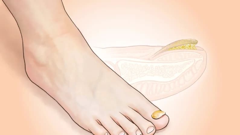 Hongos en las uñas de los pies: una infección persistente que afecta a 1 de cada 10 personas