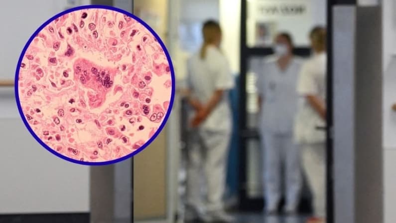 Aumentan casos de sarampión en Carolina del Sur y se extiende a otros estados