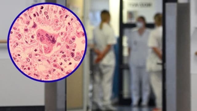 Fondo: (CHRISTOF STACHE/AFP via Getty Images) Imagen virus sarampión. (CDC via Getty Images)