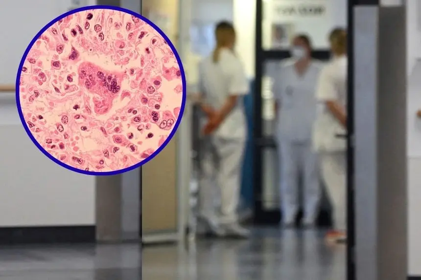 Fondo: (CHRISTOF STACHE/AFP via Getty Images) Imagen virus sarampión. (CDC via Getty Images)