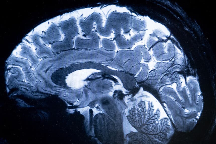 Esta imagen, obtenida con el resonador magnético Iseult Magneton 11.7 T, muestra un cerebro durante una simulación de examen de resonancia magnética (RM) en las instalaciones de Neurospin del centro de la Comisión de Energía Atómica y Energías Alternativas (CEA, por sus siglas en francés) de París-Saclay, en Gif-sur-Yvette, el 22 de marzo de 2024. "Iseult", el escáner de resonancia magnética más potente del mundo, ha proporcionado sus primeras imágenes del cerebro humano y se espera que permita comprender mejor su funcionamiento y ciertas enfermedades neurodegenerativas y psiquiátricas. Esta proeza técnica es el resultado de una colaboración franco-alemana que ha requerido más de 20 años de investigación. (Foto de Alain JOCARD / AFP) / RESTRINGIDO A USO EDITORIAL - PARA ILUSTRAR EL EVENTO COMO SE ESPECIFICA EN EL PIE DE FOTO (Foto de ALAIN JOCARD/AFP a través de Getty Images).