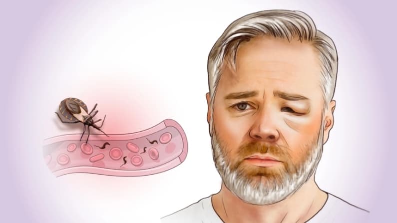 Enfermedad de Chagas: Infección oculta que se convierte en enfermedad crónica–Cómo prevenirla
