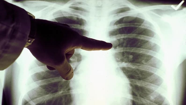Sociedad del Cáncer: El tabaquismo disminuye, pero siguen las consecuencias económicas y sanitarias