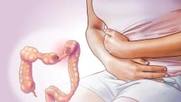 Síndrome del intestino irritable: El trastorno intestinal más común