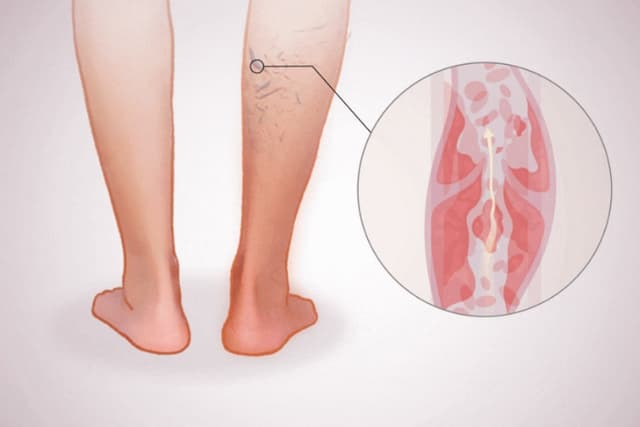 Trombosis venosa. (Ilustración de The Epoch Times, Shutterstock)