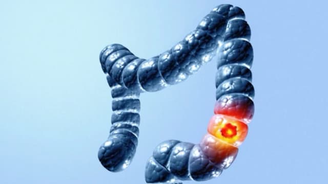 Por qué este cáncer lidera las muertes en jóvenes de EE. UU. y las fallas en su detección