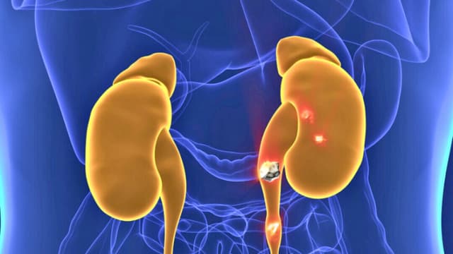 Estudio revela que los cálculos renales podrían ser colonias bacterianas