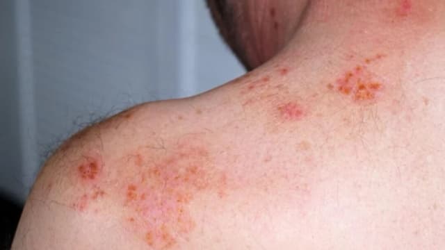 Cuando el estrés se refleja en su piel: de la repentina caída del cabello a la inflamación crónica