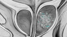 Detectan microplásticos en 9 de cada 10 muestras de cáncer de próstata en un estudio piloto