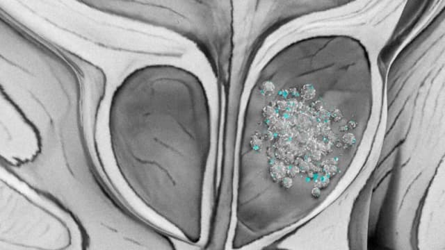 Detectan microplásticos en 9 de cada 10 muestras de cáncer de próstata en un estudio piloto