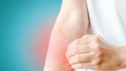 Urticaria, eczema y herpes zóster: cómo la medicina tradicional china alivia los problemas de piel