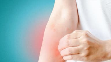 Urticaria, eczema y herpes zóster: cómo la medicina tradicional china alivia los problemas de piel