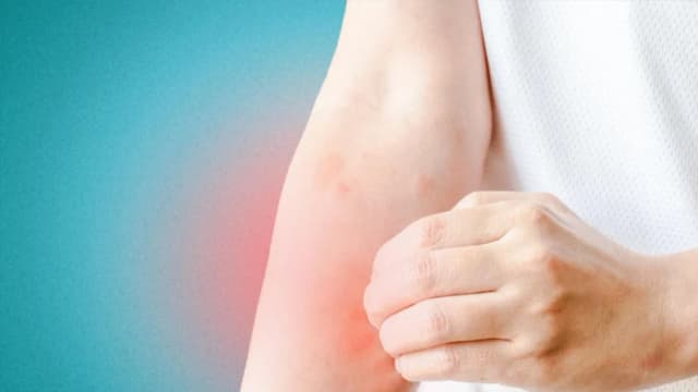 Urticaria, eczema y herpes zóster: cómo la medicina tradicional china alivia los problemas de piel