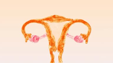 SOP: Una de las afecciones femeninas más incomprendidas ahora cambia de nombre
