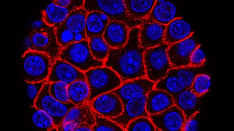 Fármaco reduce el riesgo de metástasis y muerte en el cáncer avanzado de próstata
