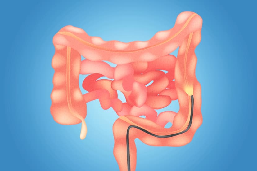Una sola sigmoidoscopia reduce el riesgo de cáncer colorrectal por más de 20 años. (The Epoch Times/Shutterstock).