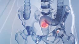 Aumenta el cáncer de recto mortal en adultos jóvenes; síntomas silenciosos que pasan desapercibidos