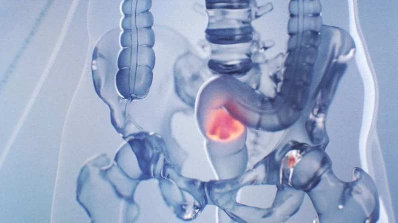 Aumenta el cáncer de recto mortal en adultos jóvenes; síntomas silenciosos que pasan desapercibidos