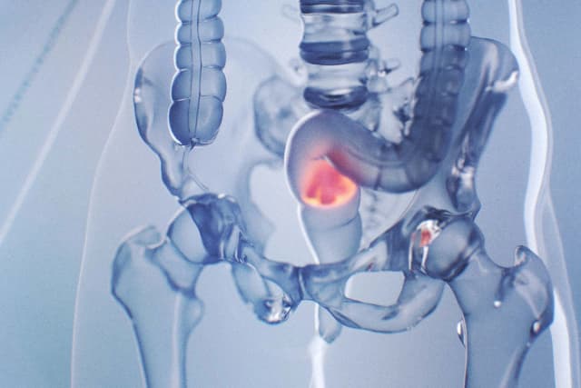 Aumenta el cáncer de recto mortal en adultos jóvenes; síntomas silenciosos que pasan desapercibidos. (3dMediSphere/Shutterstock).