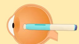 Revelan que medicamentos para la migraña podrían reducir el riesgo de glaucoma: Estudio