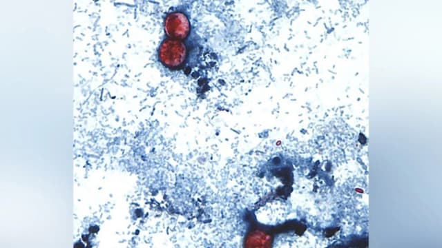 Las infecciones causadas por un parásito que provoca diarrea superan las 1000 en Míchigan