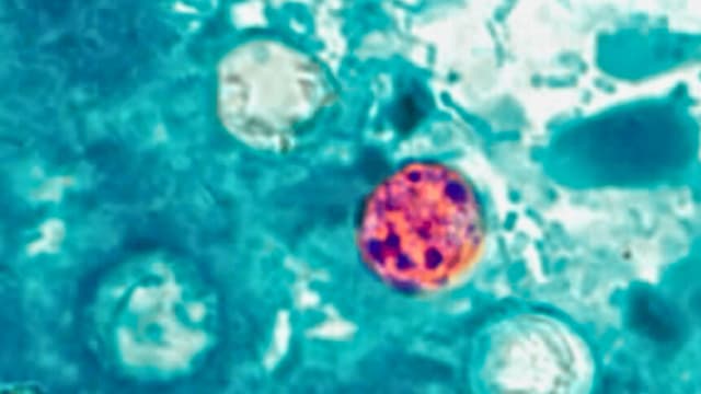 El mayor brote de ciclosporiasis en EE. UU. se extiende a nueve estados: CDC