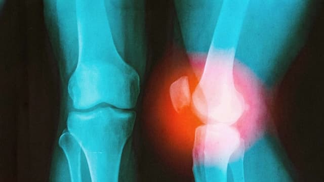 Cómo un cirujano con una lesión en la rodilla aprendió a prevenir la artritis
