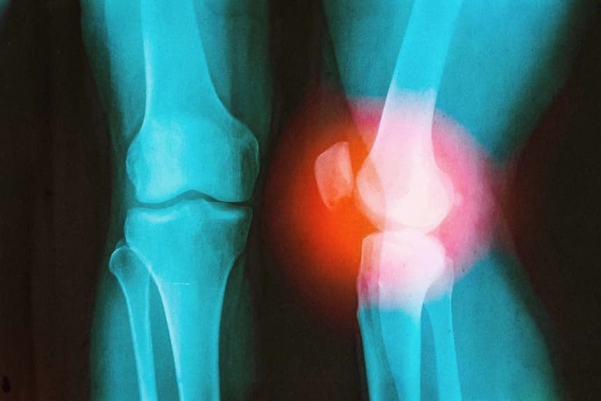 Cómo un cirujano con una lesión en la rodilla aprendió a prevenir la artritis