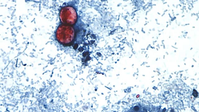 Alertan por enfermedad causada por parásito Cyclospora, ya está presente en 45 estados: CDC