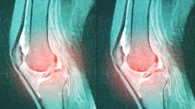 Una de las cirugías de rodilla más comunes podría hacer más daño que bien