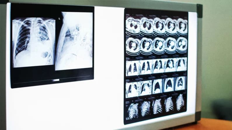Cómo un hombre desafió uno de los cánceres más mortales durante más de 7 años