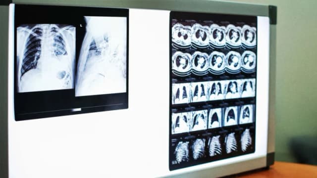 Cómo un hombre desafió uno de los cánceres más mortales durante más de 7 años
