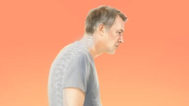 Joroba o hipercifosis: cómo revertir la curva anormal de la espalda