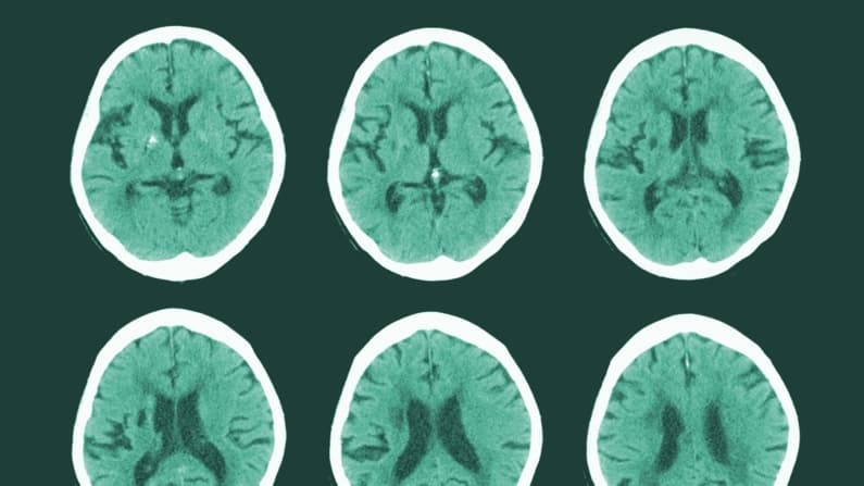 Señal de alerta de un tipo común de accidente cerebrovascular podría no ser una obstrucción, según estudio