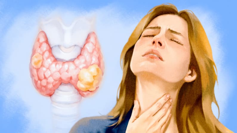 Cáncer de tiroides: silencioso pero tratable — 11 señales de alerta a las que hay que estar atentos