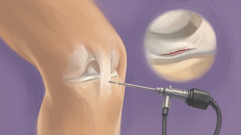 Cirugía artroscópica de rodilla: lo esencial