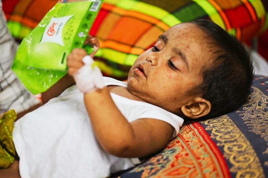 Un niño recibe tratamiento contra el sarampión en el Bangladesh Shishu Hospital & Institute de Daca, el 3 de septiembre de 2026. El brote de sarampión más mortífero de Bangladesh en décadas se acerca a la triste cifra de 1000 muertes infantiles, mientras una devastadora epidemia arrasa el país y las abarrotadas salas de los hospitales se llenan de bebés que luchan por sobrevivir. (Salahuddin Ahmed / AFP vía Getty Images)