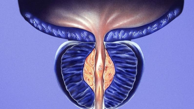 Crecimiento de próstata: cuándo buscar ayuda y cómo elegir el tratamiento