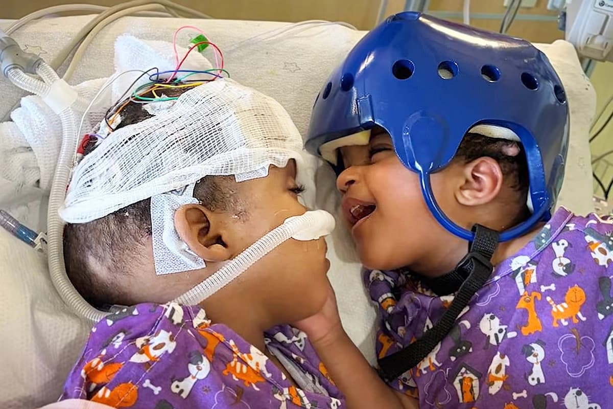 Las hermanas gemelas Hiyab y Wuhbto interactúan en una sala de recuperación del hospital tras su exitosa separación. (Hospital Infantil SSM Health Cardinal Glennon).